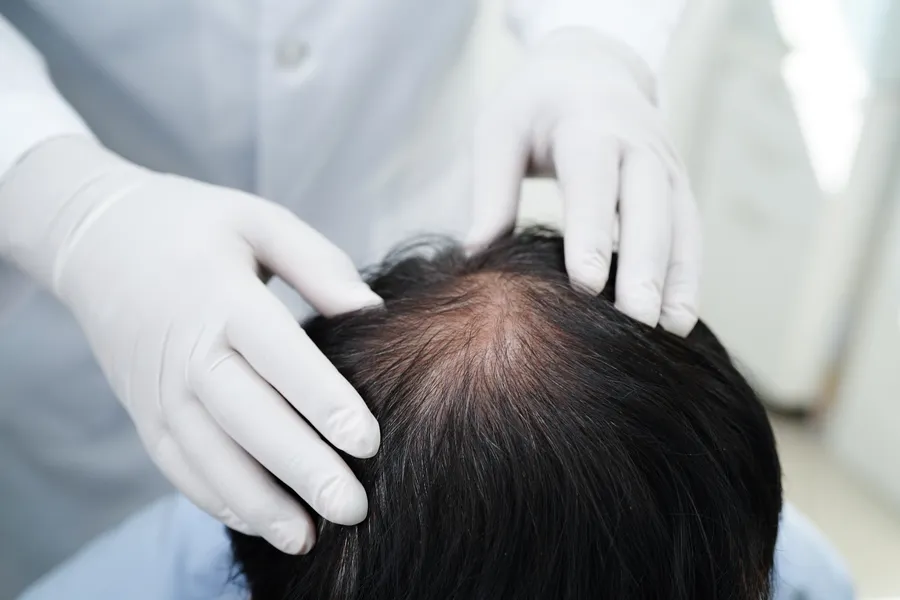 Common Myths About Hair Replacement Services Explained Schaumburg, IL Common Myths About Hair Replacement Services Explained Schaumburg, IL