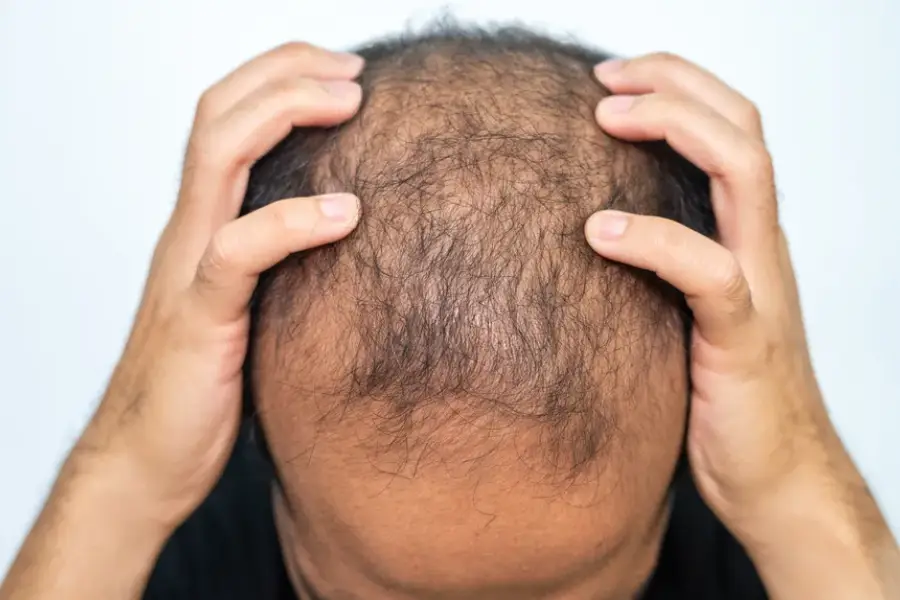 Common Myths About Hair Replacement Services Explained in Schaumburg, IL Common Myths About Hair Replacement Services Explained in Schaumburg, IL